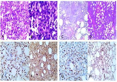 Extranodal natural killer/T-cell lymphoma invading a patient’s heart: A rare case report and literature review
